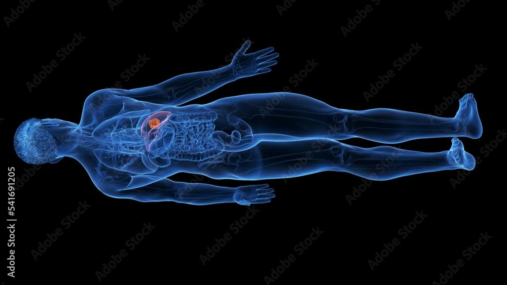 3d rendered medical animation of a liver tumor 3d rendered medical animation of a liver tumor