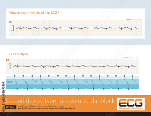 In second degree type I atrioventricular block, the PR interval is progressively prolonged until the QRS wave falls off, usually at the site of the atrioventricular node. photo