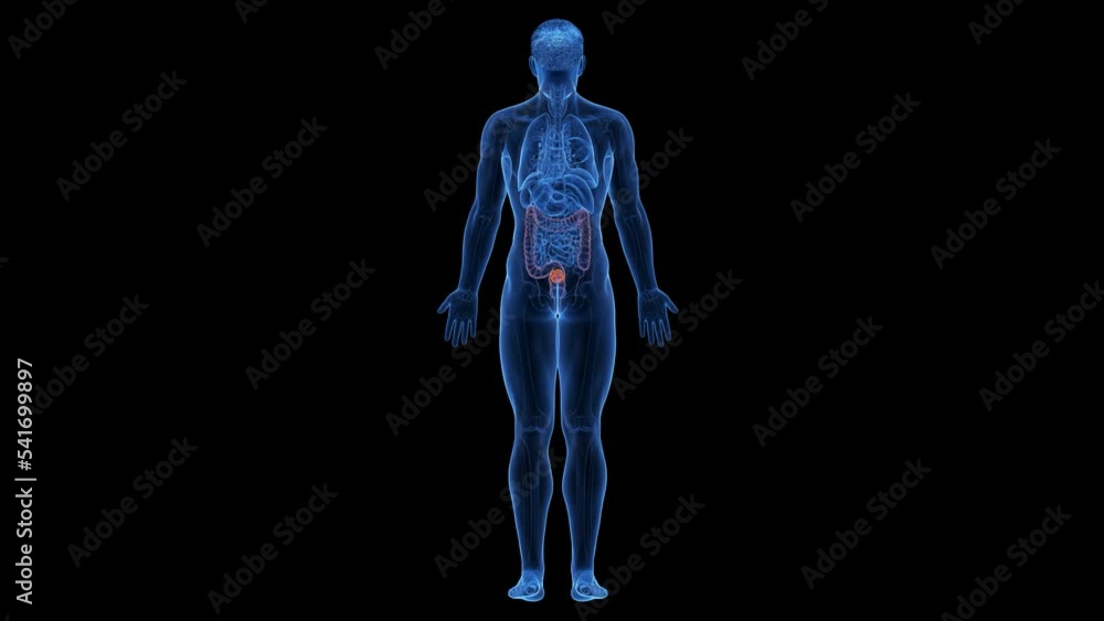 3d rendered medical animation of a rectal tumor 3d rendered medical animation of a rectal tumor