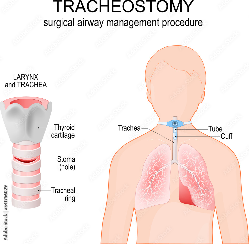 Tracheostomy. Anatomy of the trachea with stoma. larynx. Stock Vector
