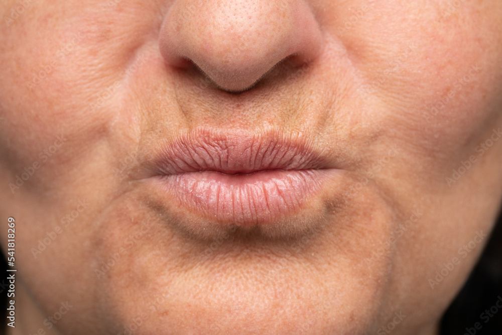 Aged lip problem in a lady's mouth Aged lip problem in a lady's mouth