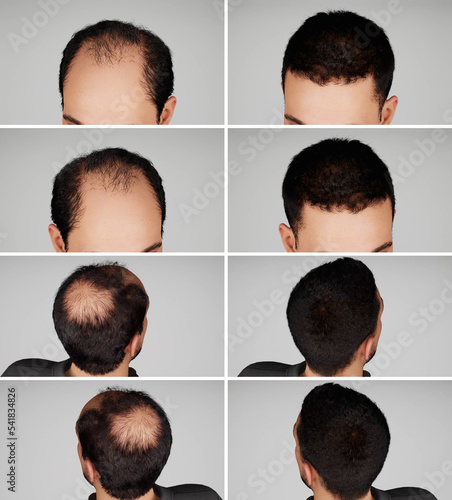 Foto 3D Render and 3D illustration Man before after hair loss treatment