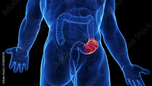 3d rendered medical animation of a constipation