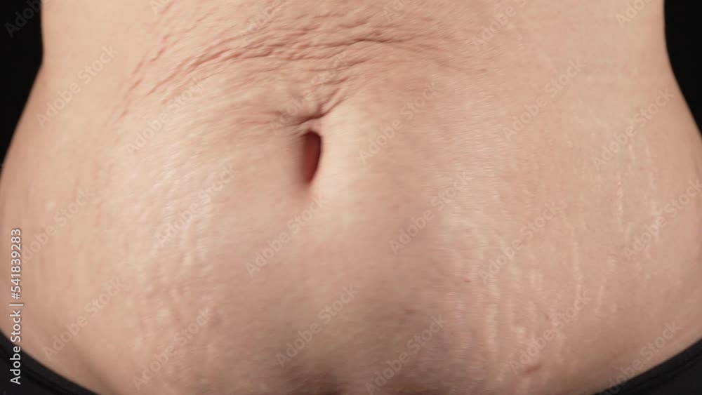 Woman with stretch marks on abdomen after pregnancy. Natural body texture. Mothers belly with heavy wrinkles,loose skin after birth child.Health care,rehabilitation,body positive,accepting Woman with stretch marks on abdomen after pregnancy. Natural body texture. Mothers belly with heavy wrinkles,loose skin after birth child.Health care,rehabilitation,body positive,accepting