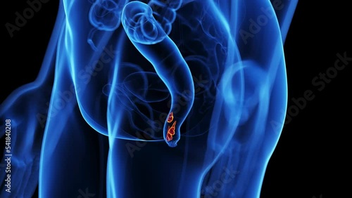 3d rendered medical animation of hemorrhoids photo