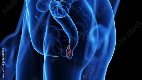 3d rendered medical animation of hemorrhoids