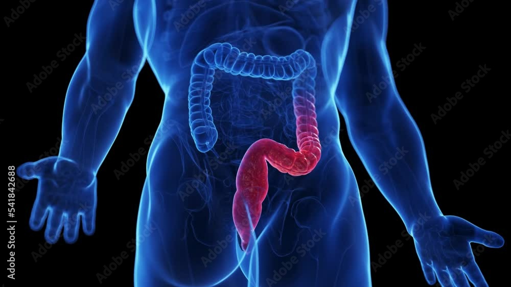 3d rendered medical animation of the colon of a man suffering from colitis ulcerosa 3d rendered medical animation of the colon of a man suffering from colitis ulcerosa