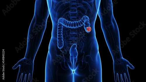 3d rendered medical animation of a colectomy 