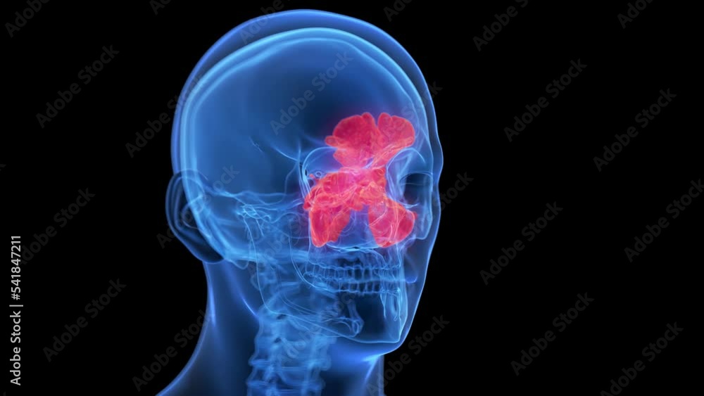 3d rendered medical animation of inflamed sinuses 3d rendered medical animation of inflamed sinuses