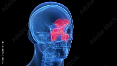3d rendered medical animation of inflamed sinuses