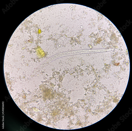 strongyloides stercoralis larva in stool exam.