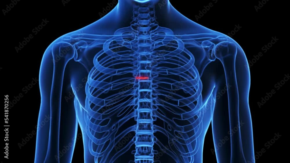 3d rendered medical animation of a broken breast bone Stock Video