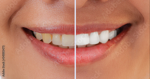 Closeup smiling asian woman Teeth comparison Before and After teeth whitening treatment from yellow to be white teeth. Dental health and oral care in adult Concept.