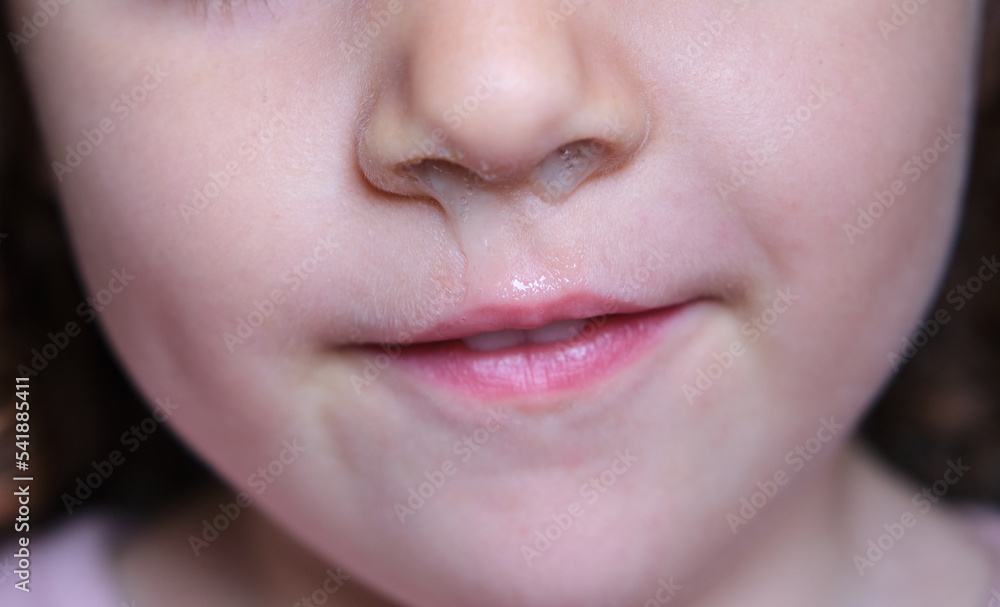 close-up of a girl's runny nose caused by a seasonal virus close-up of a girl's runny nose caused by a seasonal virus