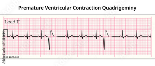 ECG Premature Ventricular Contraction Trigeminy - 8 Second ECG Paper