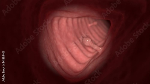 3d rendered medical animation of colon polyps photo