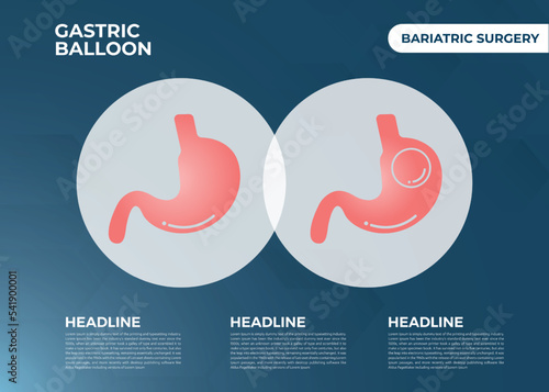 Stomach Endoscopy Gastric Balloon Inside a Stomach weight loss surgery vector illustration obesity 
