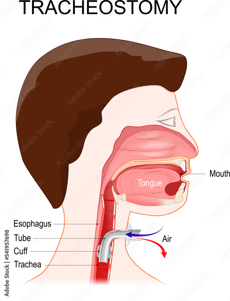 Tracheotomy. side view of the neck and the correct placement of a