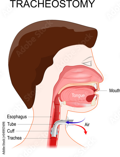 Tracheotomy. side view of the neck and the correct placement of a tracheostomy tube