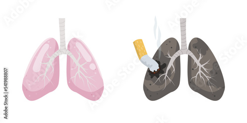 Illustration of healthy lungs vs. smoker's lungs. 
