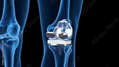 3d rendered medical animation of a knee replacement