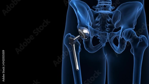 3d rendered medical animation of a hip replacement