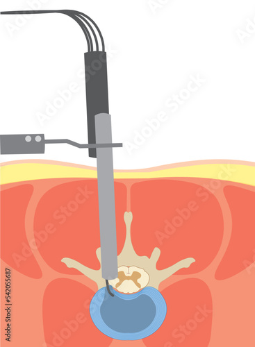 Lumbar Interbody Fusion (LIF). Spine surgery performade by a endoscopy  technique. TLIF -  Transforaminal Lumbar Interbody Fusion 