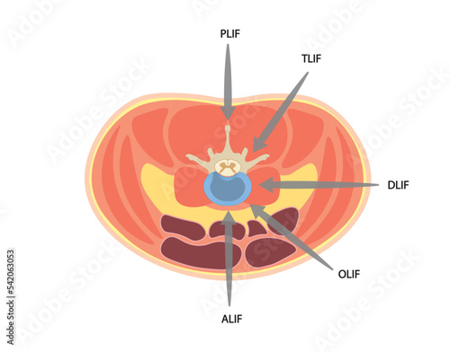 Lumbar Interbody Fusion (LIF). Spine surgery performade by a endoscopy  technique.  Different positions. ALIF, TLIF, OLIF, DLIF and PLIF 