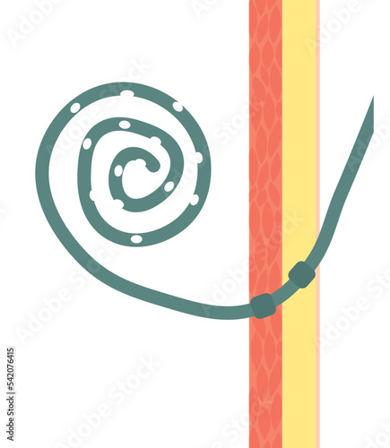 Peritoneal Dialysis Catheter illustration. Subcutaneous and deep cuff illustration in a peritoneal catheter