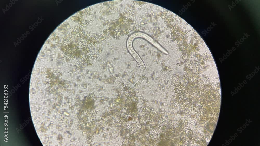 strongyloides stercoralis larva in stool exam finding with microscope