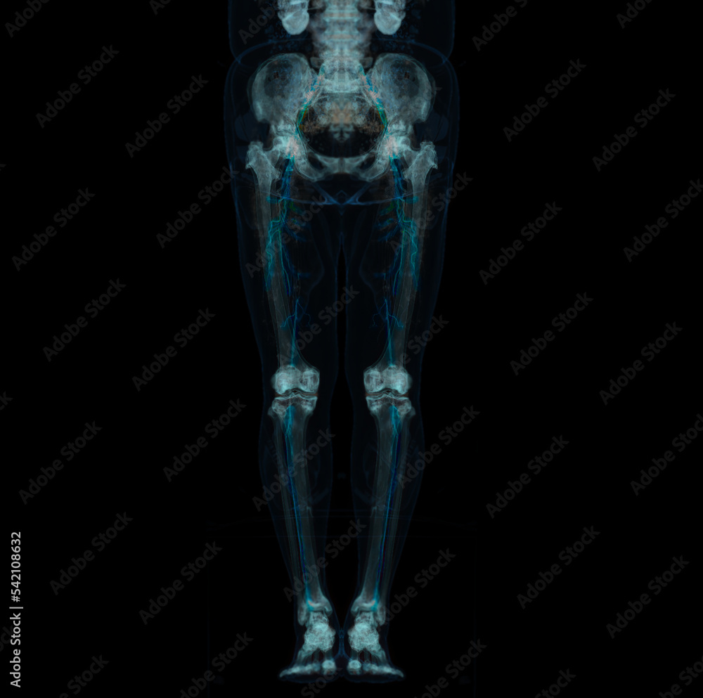 CT scan of lower extremity ,3D illustration of Femur bone , knee joint , leg and foot . CT scan of lower extremity ,3D illustration of Femur bone , knee joint , leg and foot .