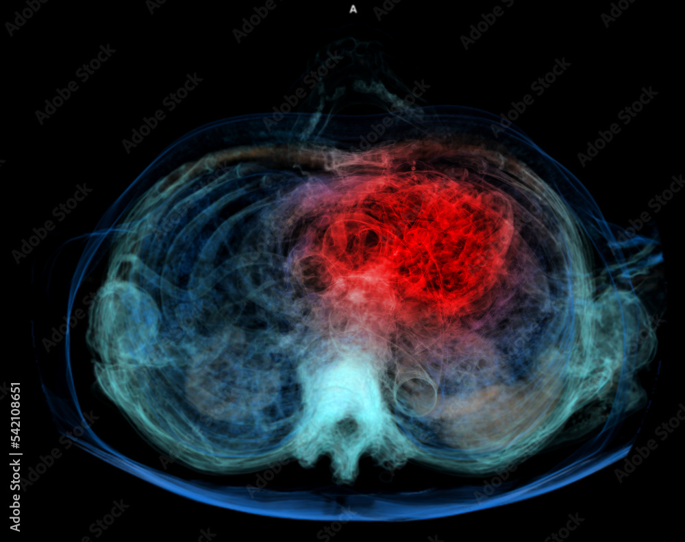 human-heart-attack-pain-as-an-anatomy-medical-disease-concept-with-a