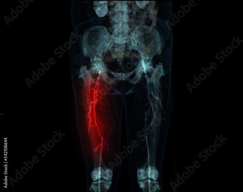 CT scan of lower extremity  ,3D illustration of Femur bone , knee joint , leg and foot . © samunella