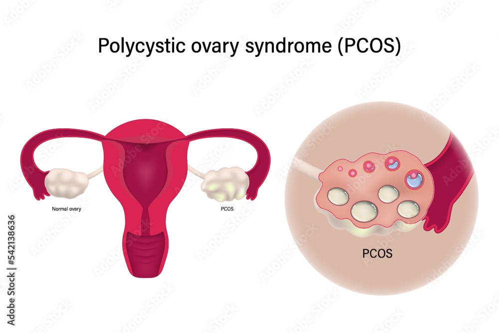 Close up of polycystic ovary syndrome PCOS. Female reproductive system