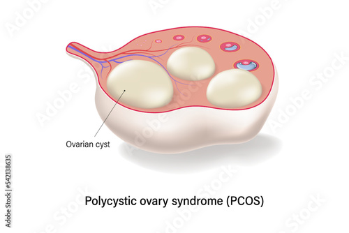 Polycystic ovary syndrome PCOS cross section vector. Ovarian cysts. Female ovarian disease. photo