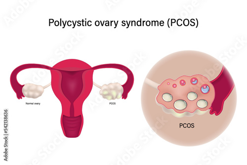Close up of polycystic ovary syndrome PCOS. Female reproductive system. Multiple immature follicles. Ovarian cysts. photo