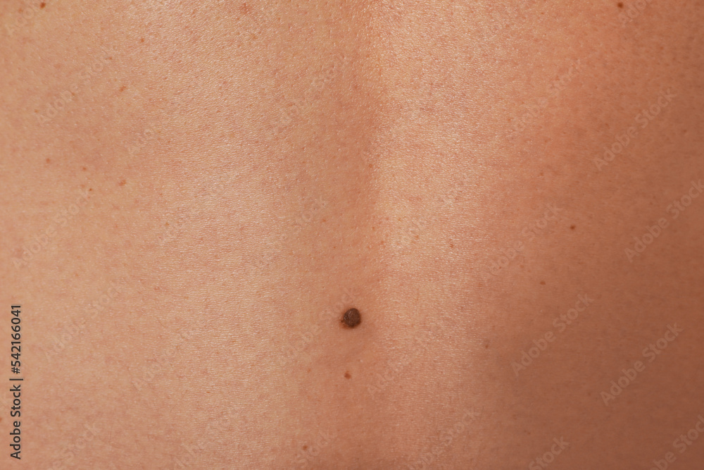 Closeup of man's body with birthmarks as background Closeup of man's body with birthmarks as background