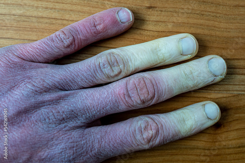 A frostbitten male hand with Raynaud's syndrome, Raynaud's phenomenon or Raynaud's disease. © Szymon Bartosz