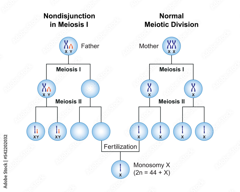 Vetor De Scientific Designing Of Nondisjunction In Monosomy X Turner klinefelter-syndrome-karyotype-cut-out-stock-images-pictures-alamy