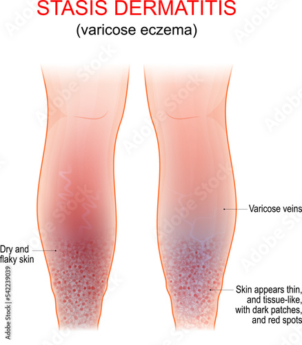 Varicose eczema. Symptoms of venous, gravitational or stasis dermatitis photo
