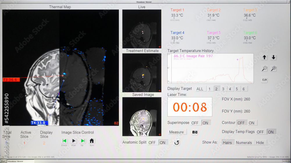 Step by step Visualase is an MRIguided laser ablation system used to