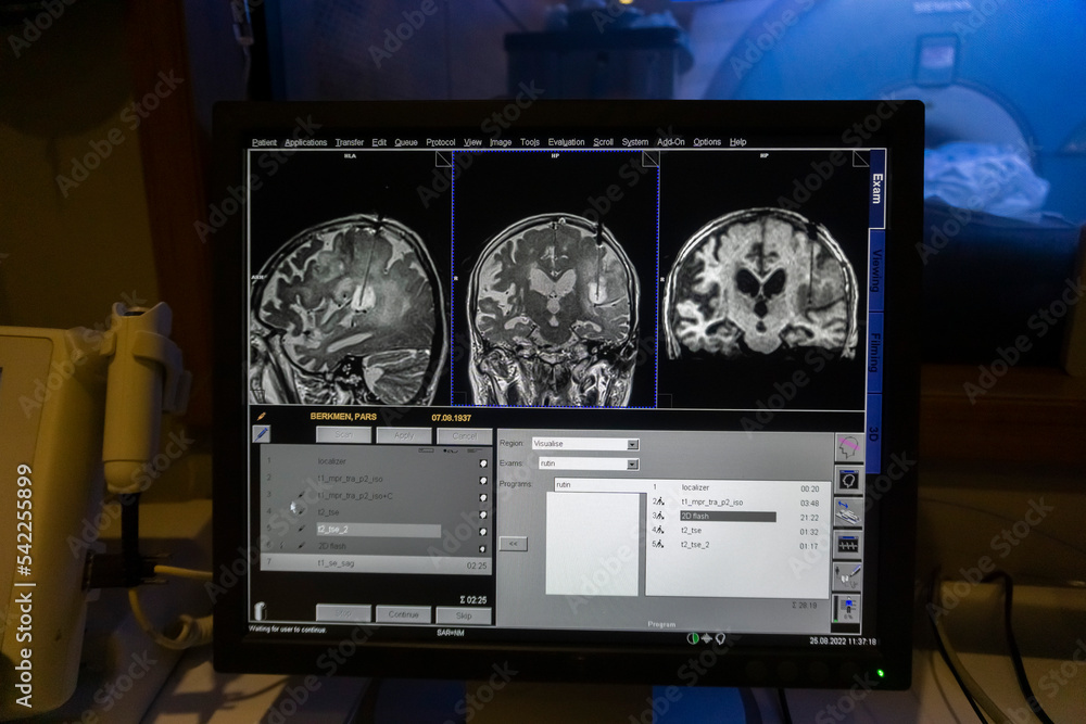 Step by step Visualase is an MRIguided laser ablation system used to