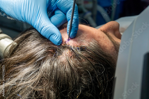 Step by step Visualase is an MRI-guided laser ablation system used to perform Laser Interstitial Thermal Therapy (LITT), a minimally invasive surgical alternative to open craniotomy. 