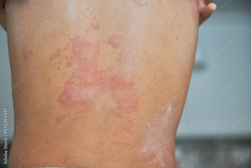 Itchy skin, dermatitis, food allergies. baby showing her back with acne