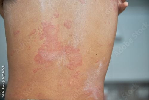 Itchy skin, dermatitis, food allergies. baby showing her back with acne, red spots. Baby's having itching, scratching her body with allergy rash..