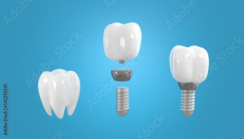 Dental implant new natural teeth 3d render illustration. Construction of dental tooth with screw and flexible ceramic crown. Tooth repair and replacement.