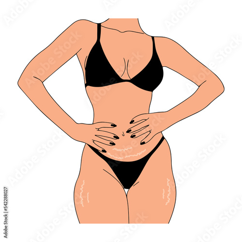 Stretch marks on the abdomen and thighs of a woman. Vector illustration.