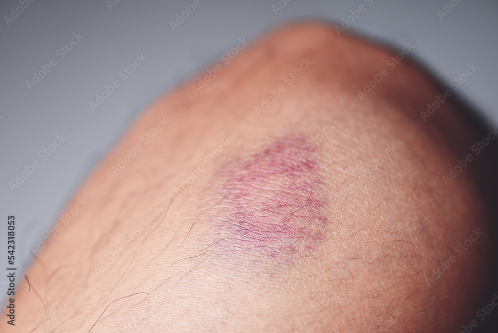 bruised on knee - wound bruised on leg caused by sports and bump or fall, leg injury bruised on knee - wound bruised on leg caused by sports and bump or fall, leg injury