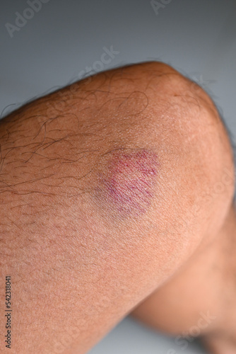 bruised on knee - wound bruised on  leg caused by sports and bump or fall  leg injury