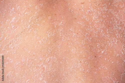 Sunburn, close-up of human skin. Flaky skin from allergies, peeling or eczema. Dry skin in need of treatment and hydration.